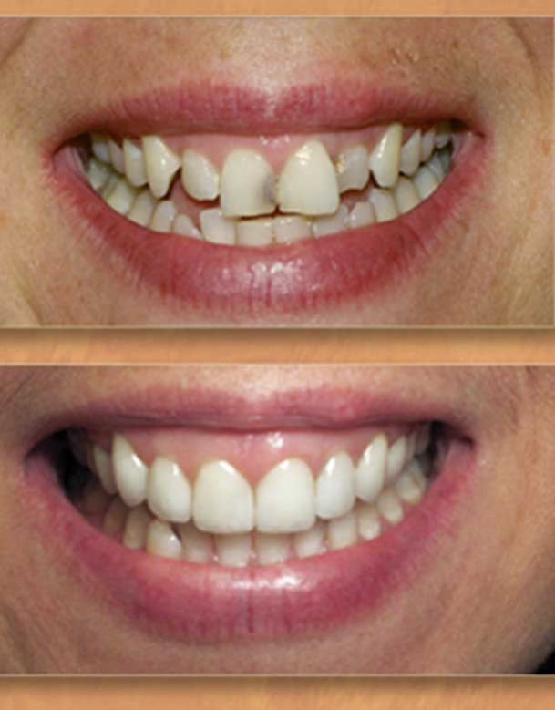 Dentista Stradella Oltrepo Pavese Faccette Dentali
