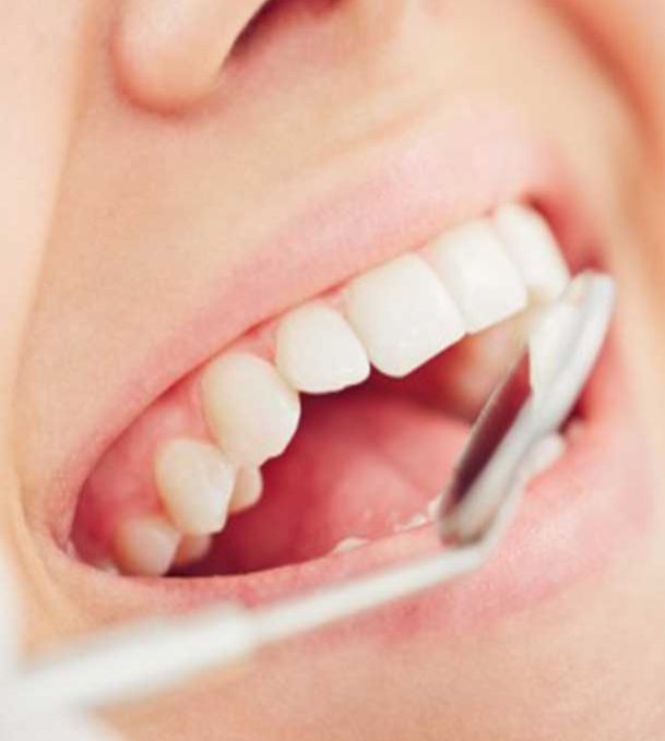 Dentista Broni, Oltrepo Pavese Pulizia Dentale, Impianti Dentali