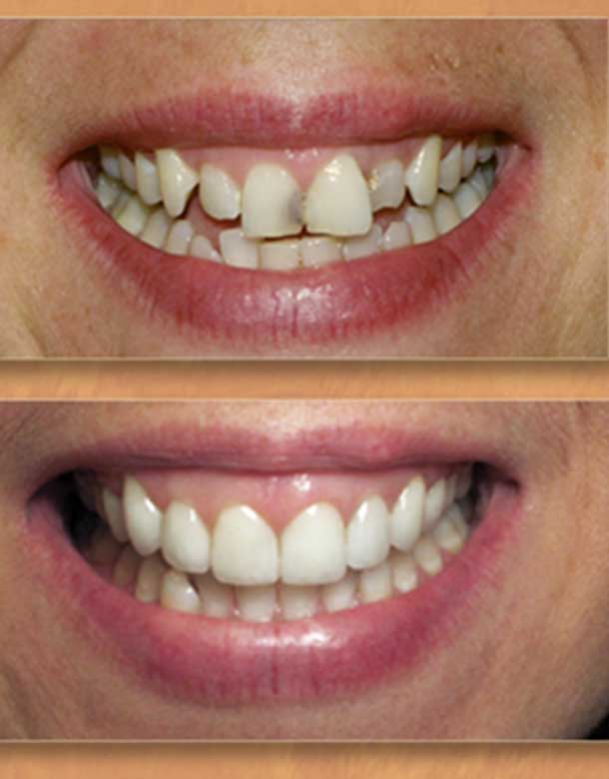 Dentista Stradella Oltrepo Pavese Faccette Dentali 